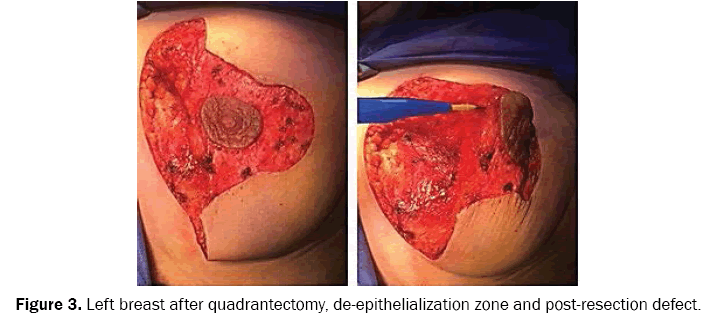 reports-in-cancer-and-treatment-post-resection