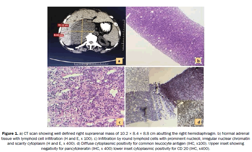 reports-in-cancer-and-treatment-suprarenal